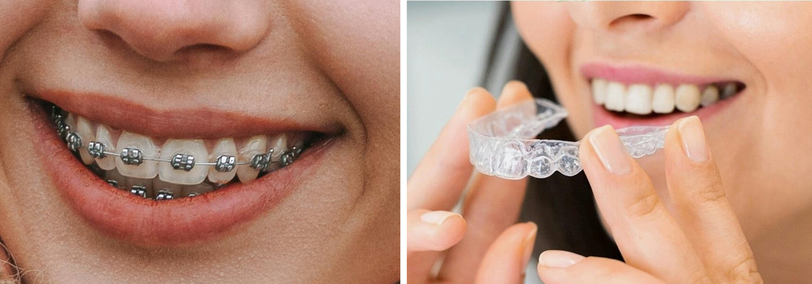 Appareil dentaire fixe